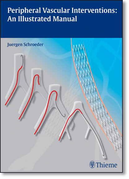 Peripheral Vascular Interventions: An Illustrated Manual, livro de Juergen Schroeder
