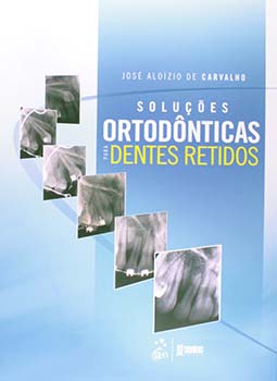Soluções ortodônticas para dentes retidos, livro de José Aloízio de Carvalho
